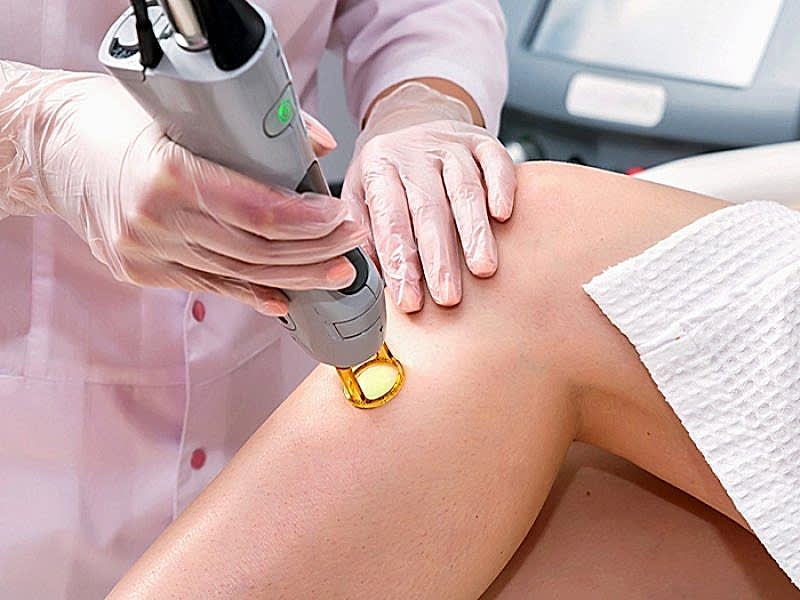 Lazer Epilasyonu Nedir